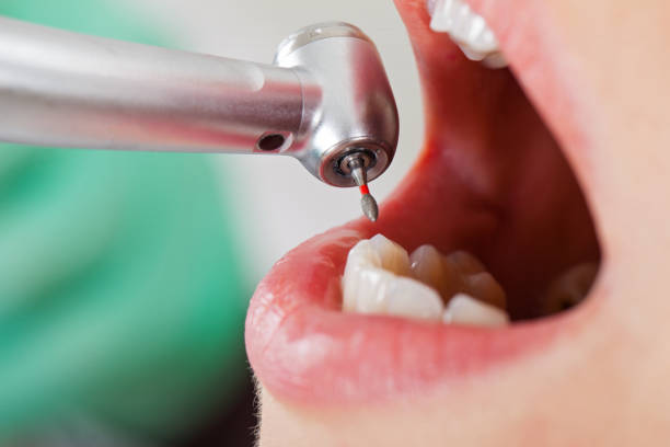 Best Emergency Dental Care for Broken or Chipped Teeth in Kenosha, WI